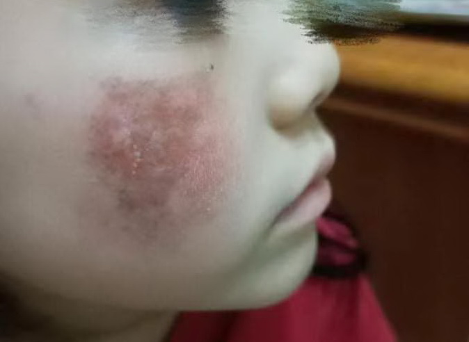 就讀私立佳佳示範幼兒園遭幼教師菜瓜布重刷，女童臉部紅腫破皮當晚返家被家長發現非常心疼。（圖／女童母姚姓新住民提供）