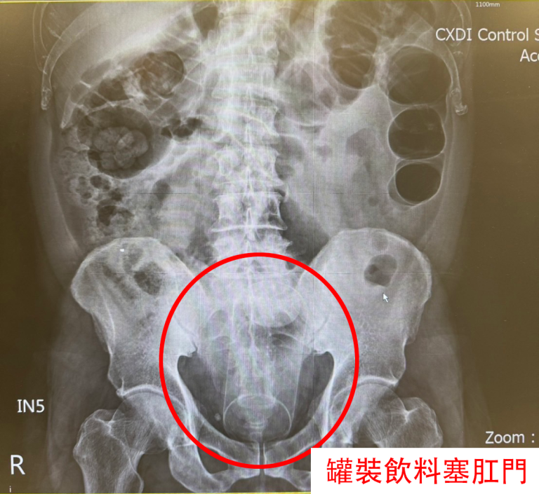 一名50歲男子三天無法排便、腹痛，就醫檢查發現肛門內卡著13公分長的罐裝飲料。（圖/記者林照東翻攝）