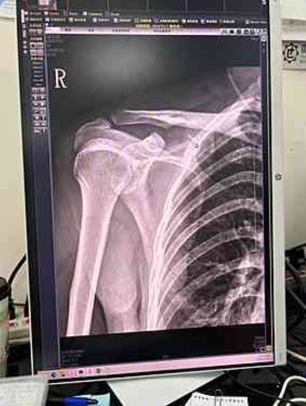 陳姓受害者除右肩胛骨骨折外，另有頭部外傷及身體多處擦挫傷。（圖／民眾提供）